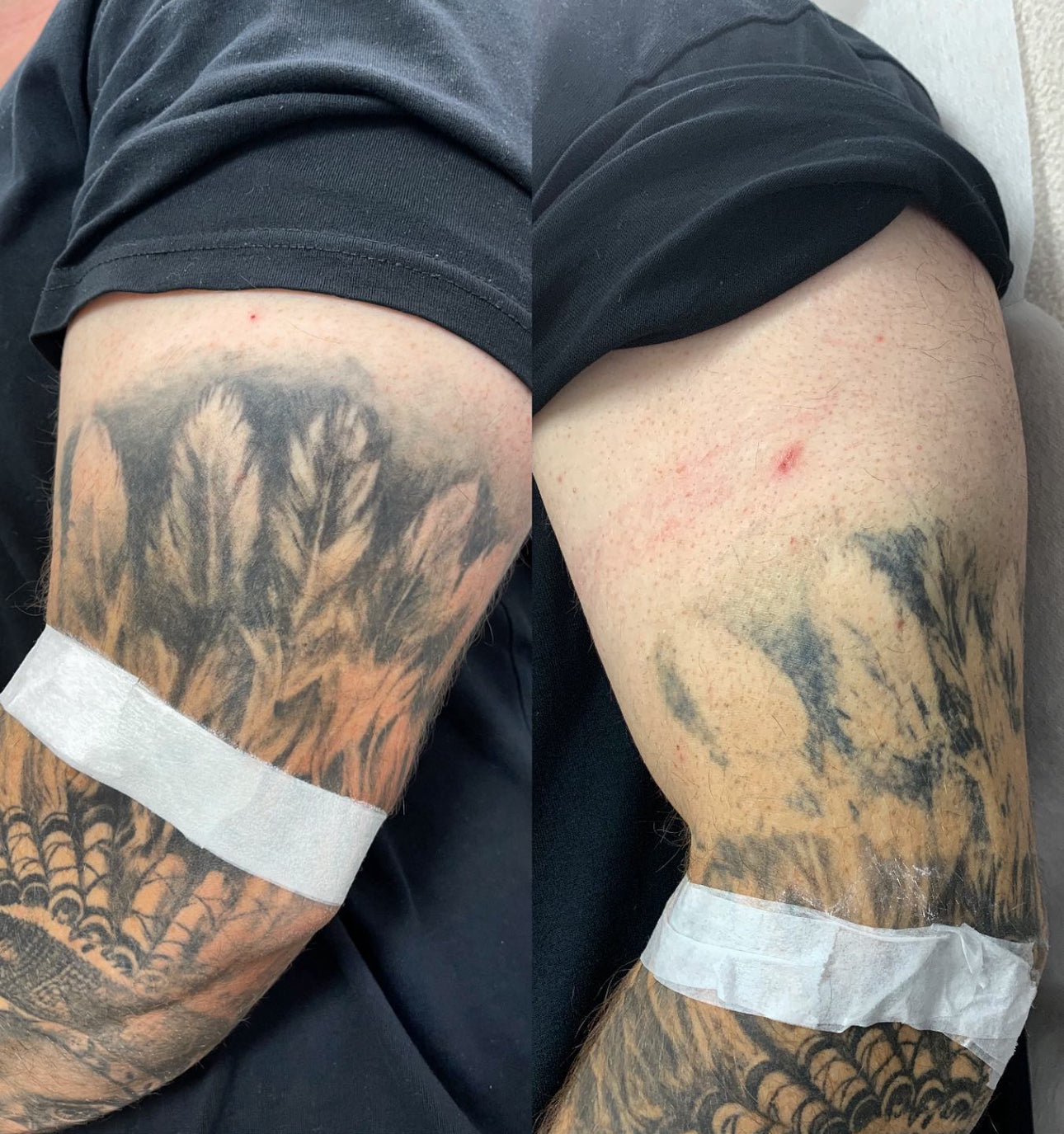 PicoSure Tattoo Removal