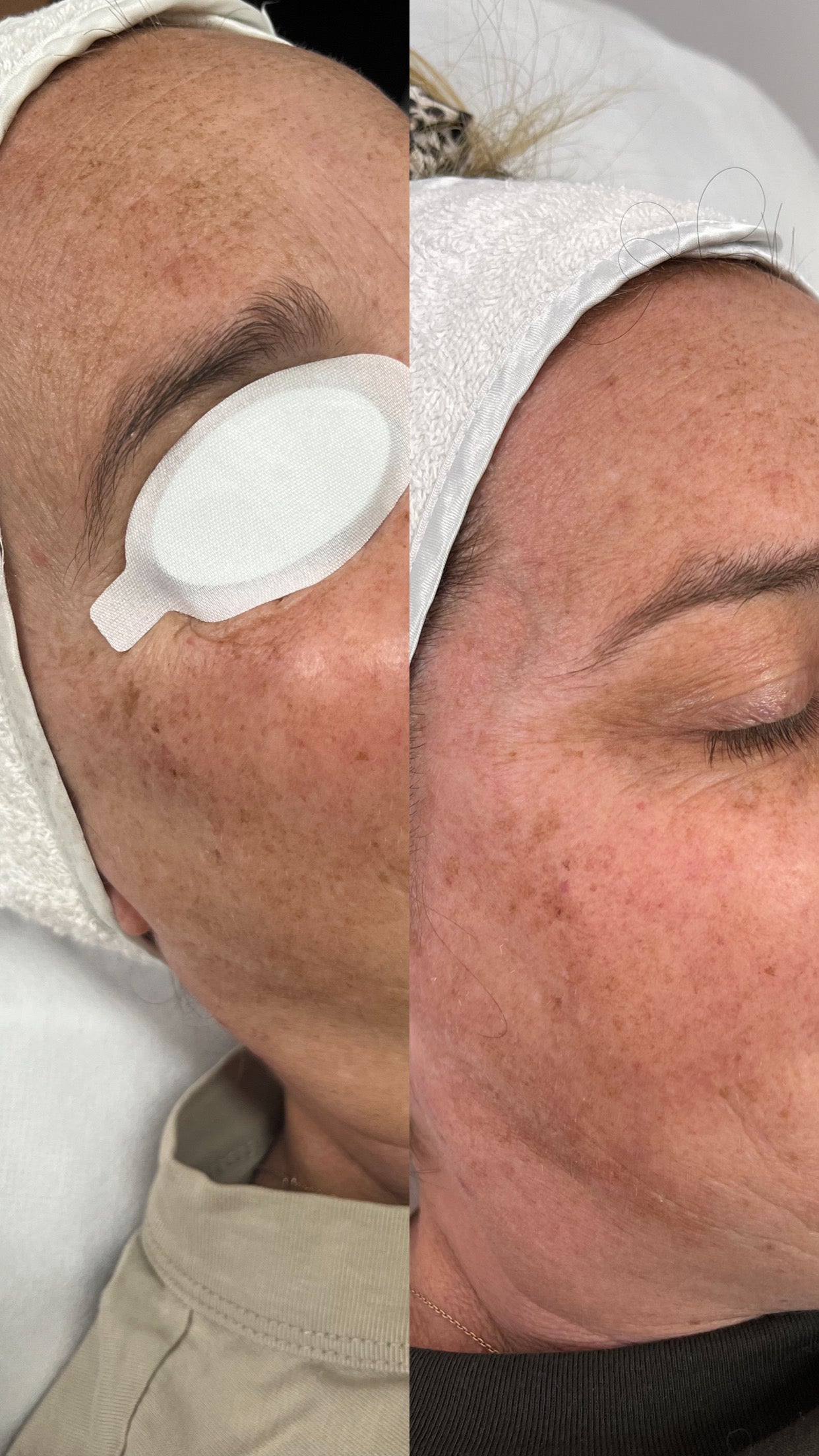 Picosure Laser Facial