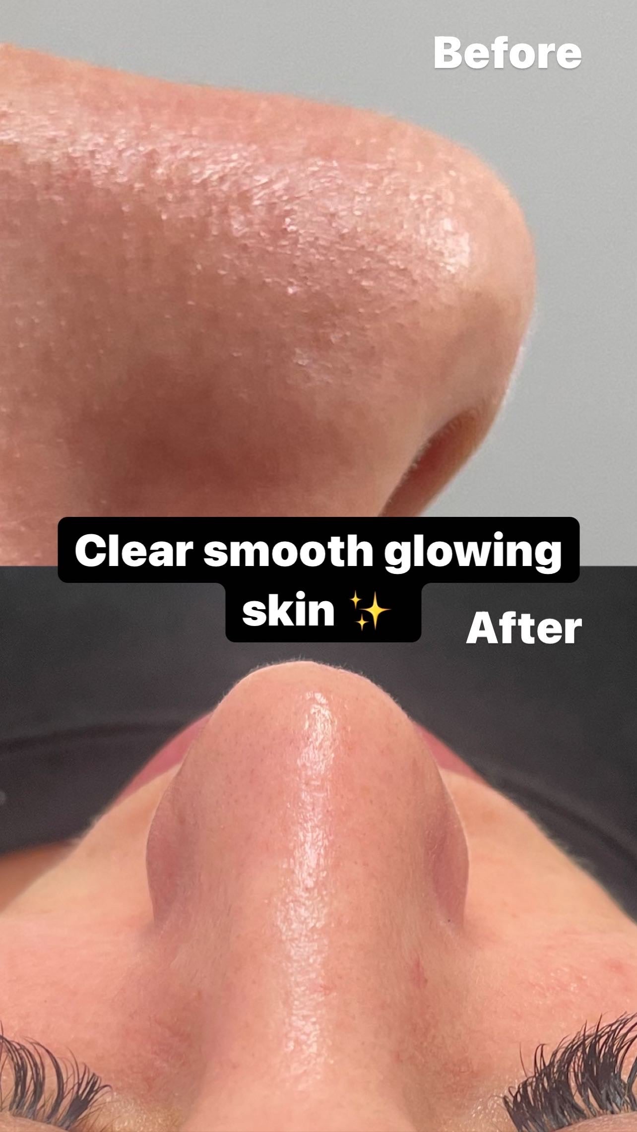 Deluxe Custom Hydrodermabrasion