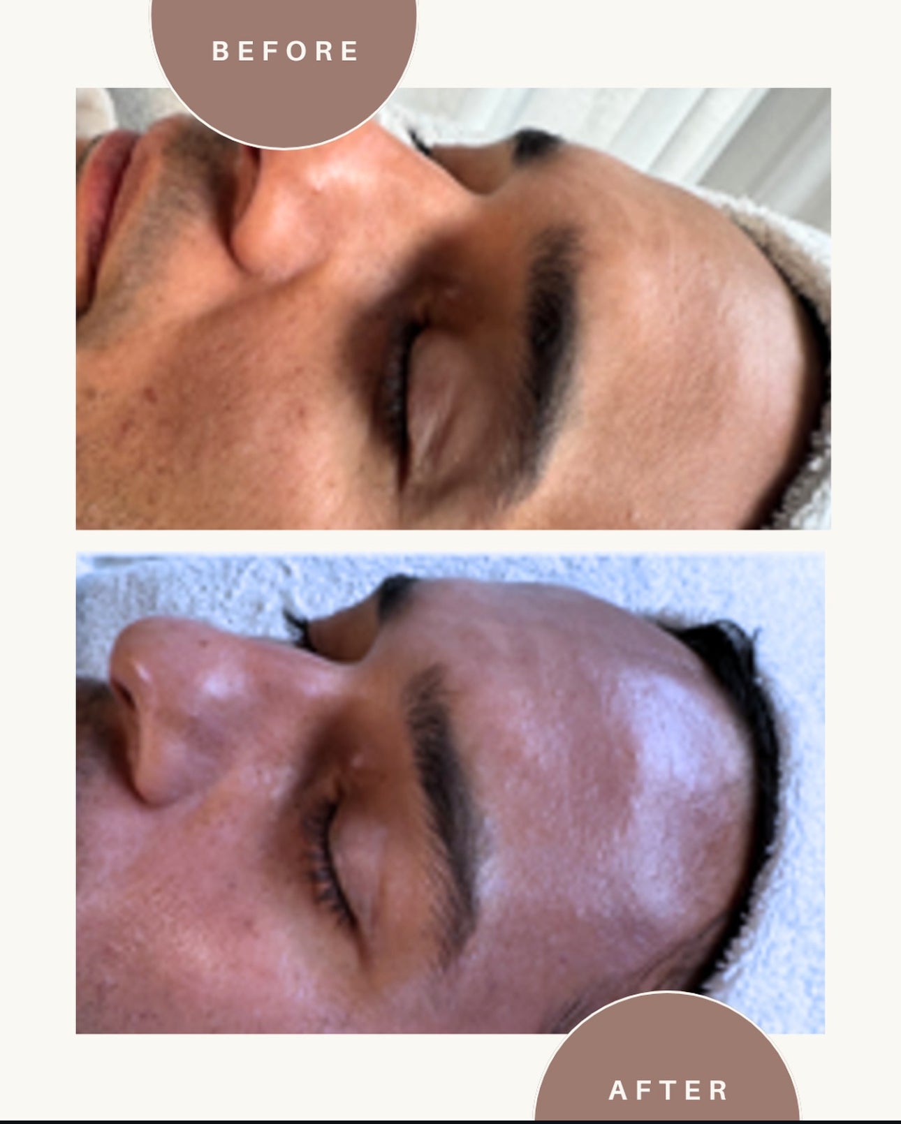 Liquid Needling with PDRN (Salmon DNA)