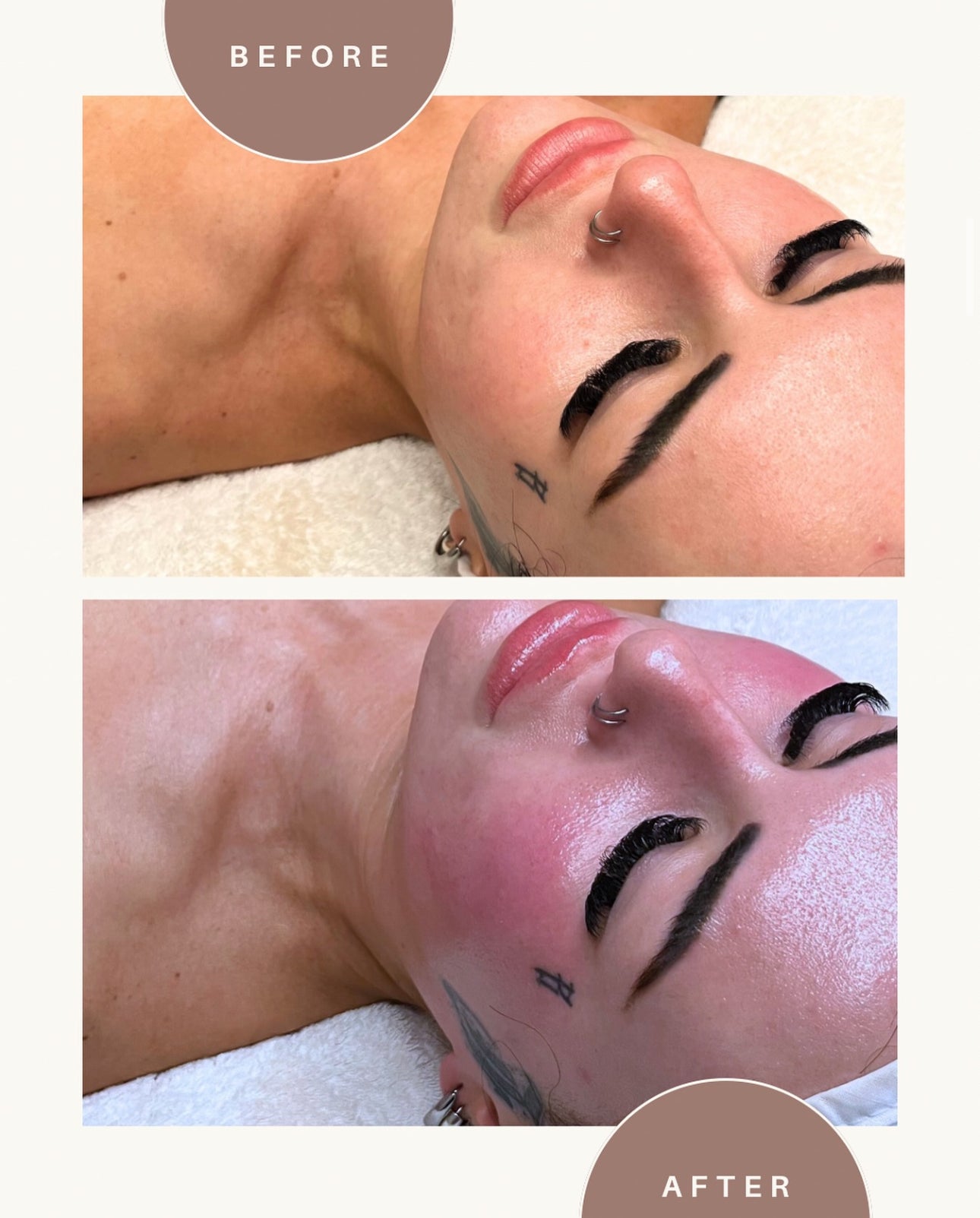 Liquid Needling with PDRN (Salmon DNA)