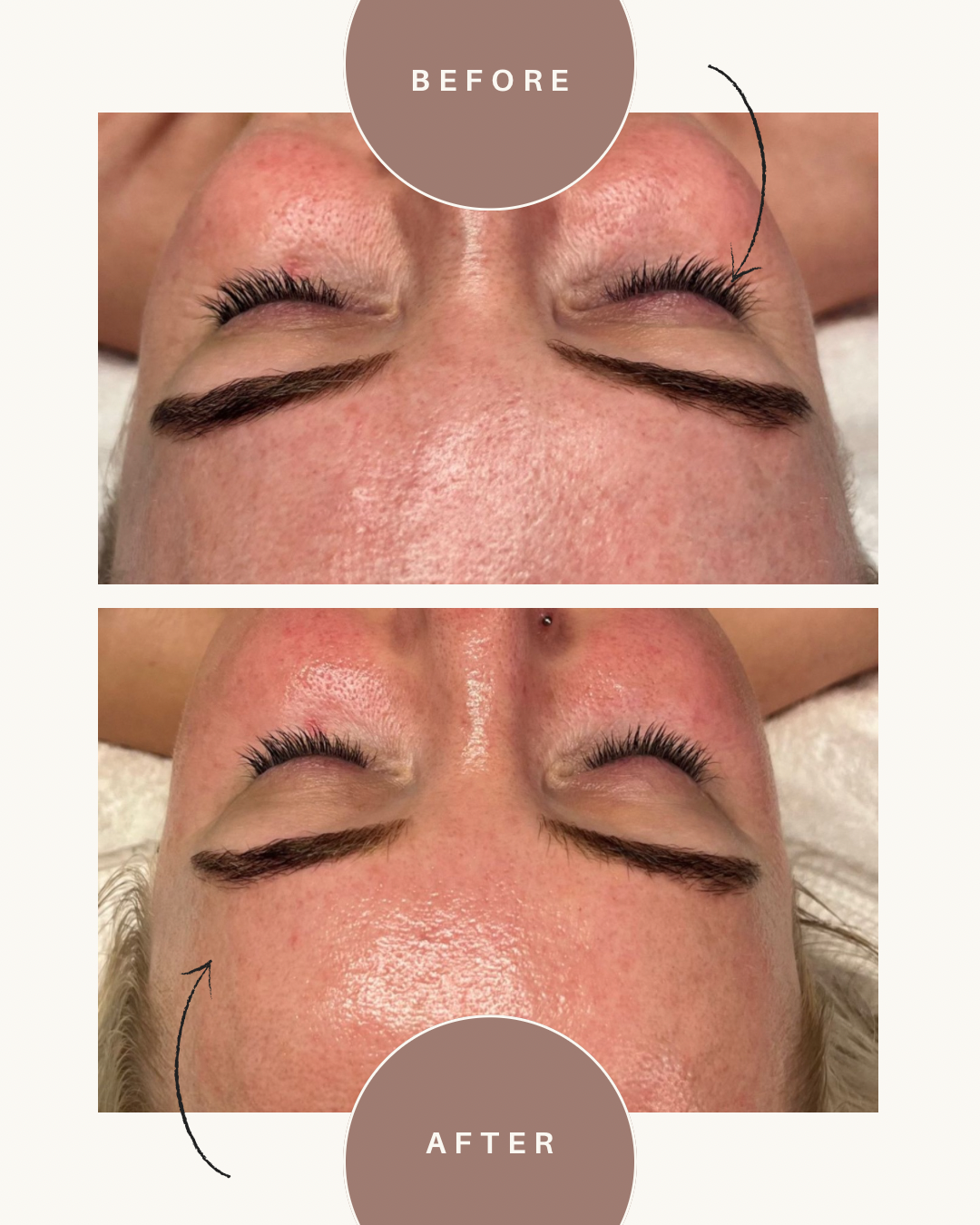 Deluxe Custom Hydrodermabrasion