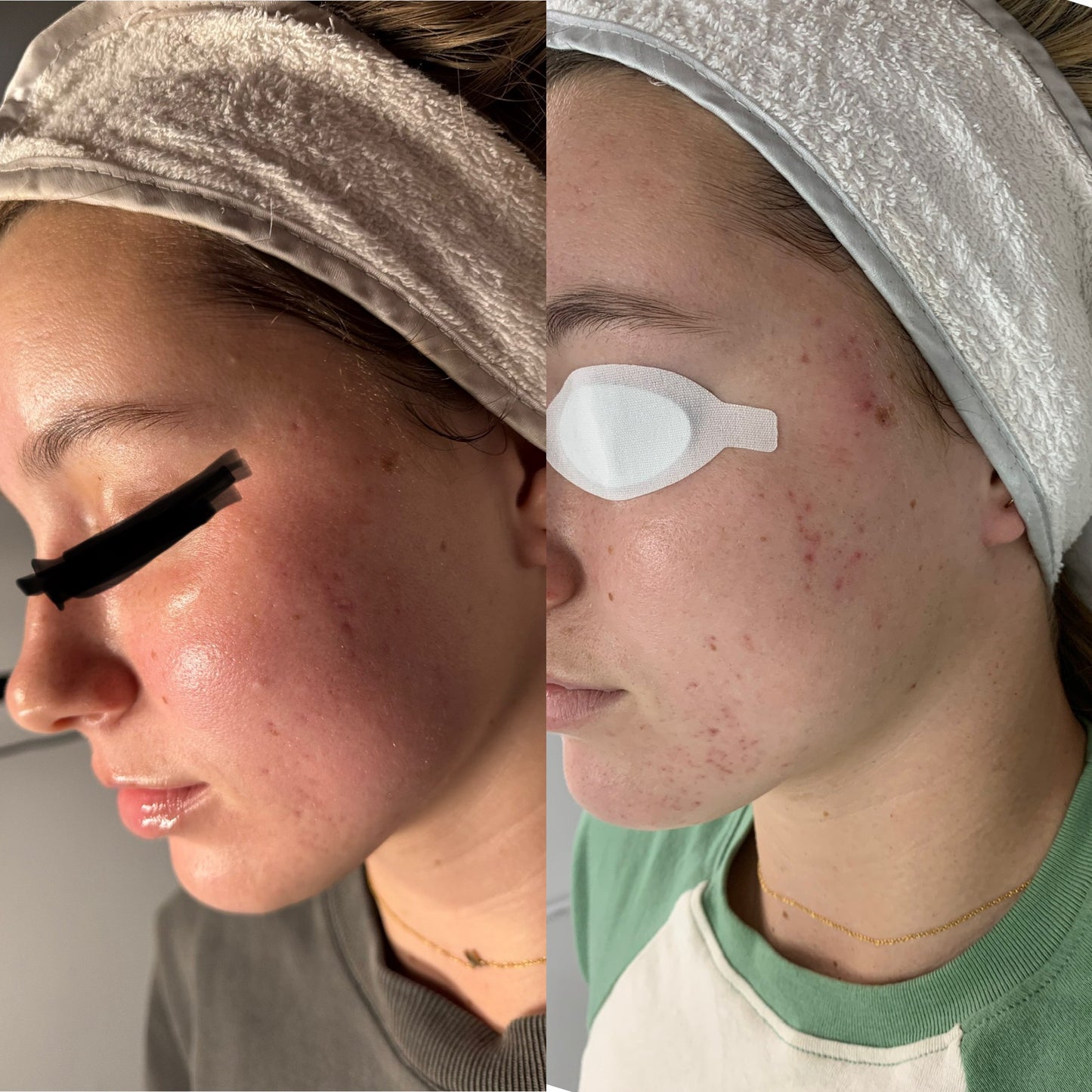 Picosure Laser Facial