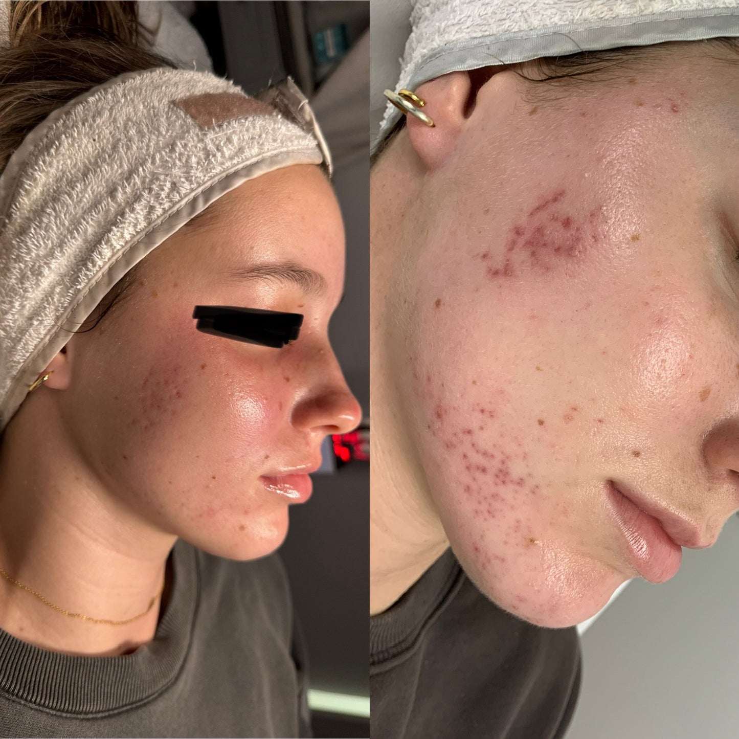 Picosure Laser Facial