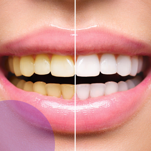 Teeth Whitening