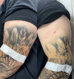 PicoSure Tattoo Removal