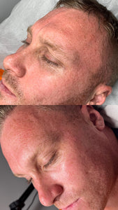 Picosure Laser Facial