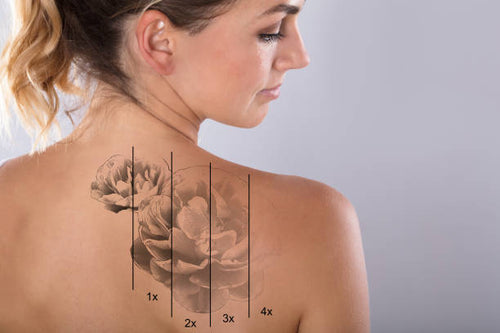 Tattoo Removal XS (5cmx5cm)