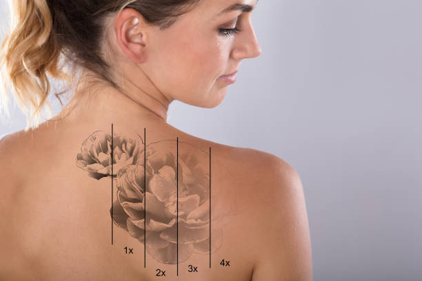 Tattoo Removal M (15cmx10cm)